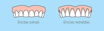 Encías retraídas: causas y tratamiento - eden.clinic