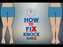 How To Fix Problem Of Knock Knee In Hindi Prem Mishra Youtube Bow Legged Correction Knock Knees Knock Knees Exercises