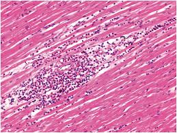 From animal models of cardiac inflammation we have detailed insight of the strain specific immune. Inflammation Of The Myocardium Endocardium And Aorta Chapter 8 Pathology Of Heart Disease In The Fetus Infant And Child