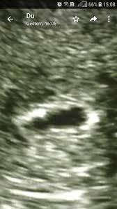 Leere Fruchthohle Das 6 1 Gesundheit Schwangerschaft