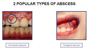 How To Cure An Abscess Tooth Pain: Dental Abscess Treatments & Remedies