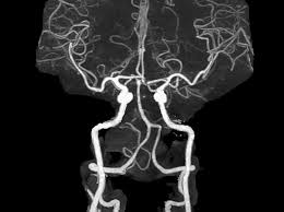The translation needs to be checked. Anatomic Circle Of Willis Variations Equally Common In Migraineurs And Non Migraineurs Neurology Advisor