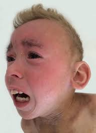 Do you know this syndrome? Ichthyosis associated with neurological  condition and alteration of hairs