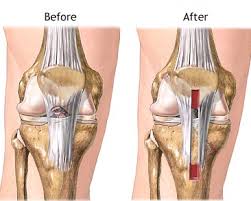 Pin On Acl Meniscus Knee