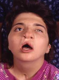 CHARGE 101: Diagnosis, Features, and the Importance of Sensory Deficits