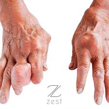 Image result for gout