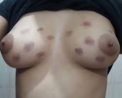 Hickeys on breasts - roopsquare.in