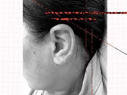 Image result for Relapsing Polychondritis