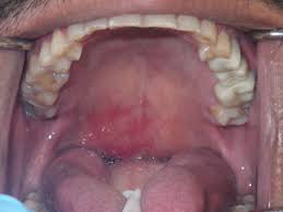 Image result for Oral herpes roof of mouth