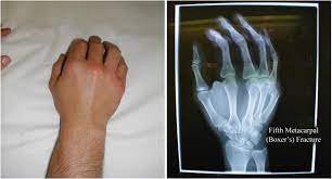Occasionally it is used to refer to fractures of the 4th metacarpal as well. Boxer S Fracture Right Hand 2 Note Swelling Over Grepmed