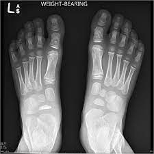 Kohler Disease Radiology Case Radiopaedia Org Radiology Radiology Imaging Pediatric Radiology