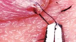 On this day in 2004, xie qiuping from china was confirmed to have the…» Ingrown Hair Guinness World Record Longest Ingrown Hair