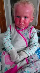 Toddler with severe psoriasis called 'lobster' and shunned by strangers who  ask if she is contagious
