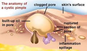 Folliculitis or small red bumps on the tattoo that won't heal even with antibiotics treatment. Tattoo Pimples How To Treat And Avoid Painful Pleasures Community