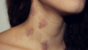 How To Remove A Hickey Overnight 2 How To Remove Love Bites Hickeys