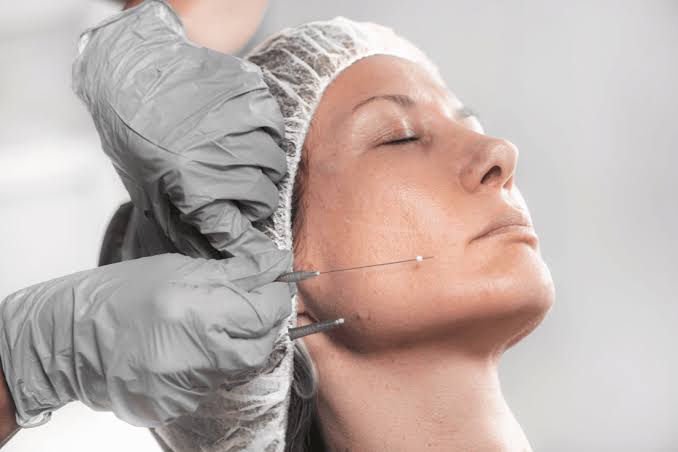 A Modern Alternative to Surgery: MINT Mono Threads
