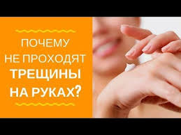 как избавиться от экземы на руках в домашних условиях Treshiny Na Rukah I Ekzema Mazhete Kremami Pochemu Ne Prohodit Youtube Naturopatiya Zdorove Naturalnye Sredstva