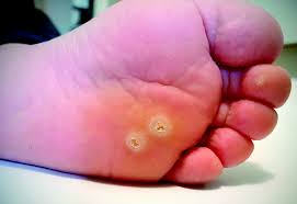Warts pictures / images of different wart types. Current And Emerging Concepts In Wart Treatment Podiatry Today