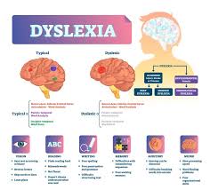 Optometry Services For Dyslexia In Austin San Antonio Tx The Optometry Center For Vision Therapy