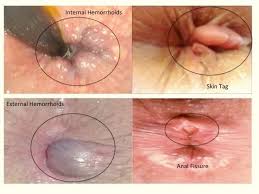 In this video clip of internal haemorrhoids below, you can clearly see the bulging blue veins around the base of the black endoscopy probe. Pictures And Photos Of Internal And External Hemorrhoids