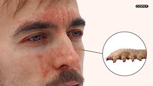 Image result for Demodex folliculorum