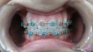 The component used to wire the braces is generally stainless steel. Pretty Braces Color Combinations