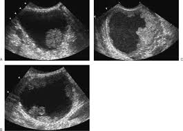 A muscular organ in the female pelvis. Ultrasound Evaluation Of The Adnexa Ovary And Fallopian Tubes Radiology Key