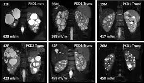 Most of the disease seen by pathologists is. Image Texture Features Predict Renal Function Decline In Patients With Autosomal Dominant Polycystic Kidney Disease Kidney International