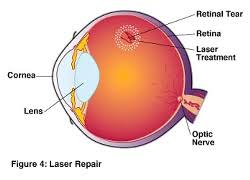 We did not find results for: Madison Eye Associates Optometry In Marco Island Fl Usa Detached Or Torn Retina Madison Eye Associates Optometry In Marco Island Fl Usa