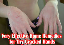 Very Effective Home Remedies For Dry Cracked Hands Medi Queen Home Remedies Natural Skin Care Diy Cold Home Remedies