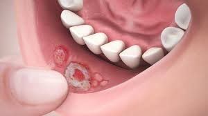 Image result for Canker sores roof of mouth