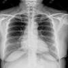 Copd patients present with progressive dyspnoea and chronic productive cough. 1