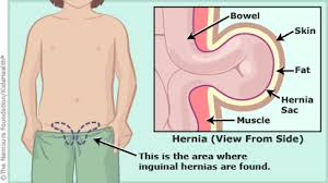 The treatment of groin hernia can be divided into five eras. Inguinal Hernias For Parents Nemours Kidshealth