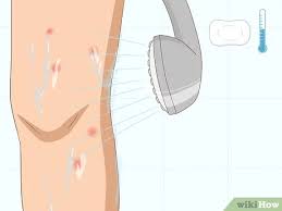 About mosquitoes bites, symptoms after a bite, how to treat a bite, complications, and bite prevention tips. 3 Easy Ways To Heal Mosquito Bites Fast Wikihow