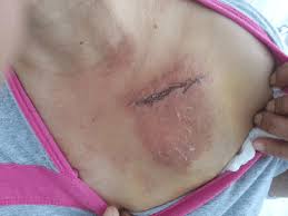 Paces the heart muscles by providing an electrical impulse. This Photograph Shows The Skin Reaction Over The Pacemaker After The Download Scientific Diagram