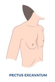 Image result for Pectus Excavatum