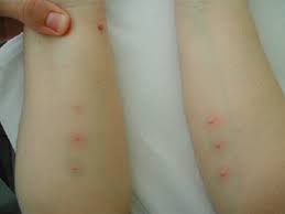 Image result for Pathergy