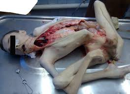 autopsy :: медицина(MR) :: жесть  голые девки, члены, голые девки с  членами, дрочево, гуро, извратское порно и прочая половая ёбля - смотреть  бесплатно!