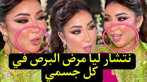 شاهد الآن دنيا بطمة انتشر في وجهها مرض البرص (البهاق) الجمهور أثار موجة  تعاطف ما حقيقة مرض دنيا بطمة