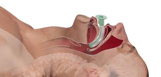 Airway Sesan Tibbi Urunler Faaliyetler