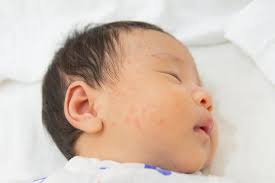 Bé bị rôm sảy tắm lá gì? 12 loại lá tắm an toàn hiệu quả cho trẻ -