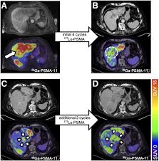 The earlier the detection of prostate cancer, the better the patient's chance of survival is. Additional Local Therapy For Liver Metastases In Patients With Metastatic Castration Resistant Prostate Cancer Receiving Systemic Psma Targeted Therapy Journal Of Nuclear Medicine