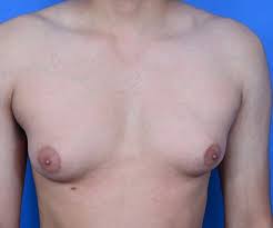 Why Does My Gynecomastia Look Better When It's Cold? | AGC