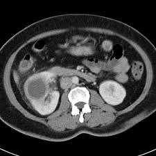 Renal Abscess Radiology Case Radiopaedia Org Radiology Small Bowel Obstruction Bowel Obstruction