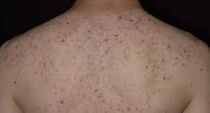 Lemon juice is another best back acne scars treatment. Home Remedies To Get Rid Of Back Acne Scars Naturally