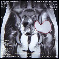 Jan hein van waesberghe, marieke hazewinkel and milou busard. Removal Of An Endometrioma Passing Through The Left Greater Sciatic Foramen Using A Concomitant Laparoscopic And Transgluteal Approach Case Report Bmc Women S Health Full Text