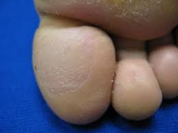 Image result for Pitting nails feet