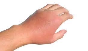 Any infection, however, could lead to sepsis. Sepsis U Narkozavisimyh Pervaya Narkologicheskaya Klinika