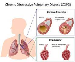 Region 10 Ccdc – Emphysema