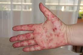 This image shows how hand, foot, and mouth disease presents on the hands. Hand Foot And Mouth Disease Is Highly Contagious This Is How To Protect Yourself Abc News